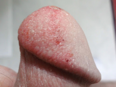 Burning sensation on tip of penis Confirm. Burning sensation on tip of penis